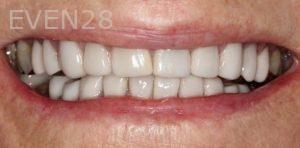 Claire-Cho-Porcelain-Veneers-Before-27