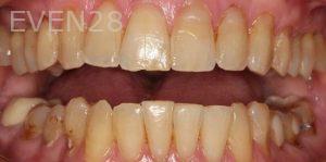 Claire-Cho-Porcelain-Veneers-Before-28