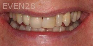 Claire-Cho-Porcelain-Veneers-Before-29