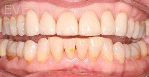 Claire-Cho-Porcelain-Veneers-Before-3