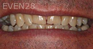 Claire-Cho-Porcelain-Veneers-Before-30