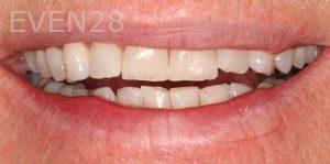 Claire-Cho-Porcelain-Veneers-Before-31