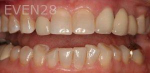 Claire-Cho-Porcelain-Veneers-Before-4