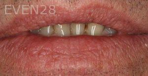 Claire-Cho-Porcelain-Veneers-Before-5
