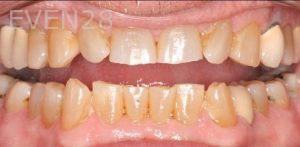 Claire-Cho-Porcelain-Veneers-Before-6