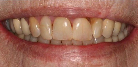 Claire-Cho-Porcelain-Veneers-Before-7