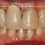 Claire-Cho-Porcelain-Veneers-Before-9