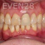 E-M-Makhoul-invisalign-clear-aligners-after-5