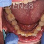 E-M-Makhoul-Invsialign-clear-aligners-before-4