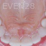 Joseph-Kabaklian-invisalign-Clear-Aligners-After-3