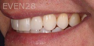 Joseph-Kabaklian-Dental-Crown-After-1