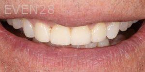 Joseph-Kabaklian-Dental-Crown-After-2