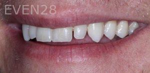Joseph-Kabaklian-Dental-Crown-Before-1