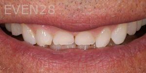 Joseph-Kabaklian-Dental-Crown-Before-2