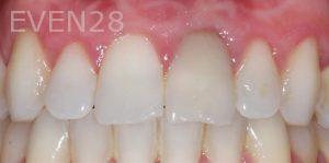 Joseph-Kabaklian-Teeth-Whitening-After-2