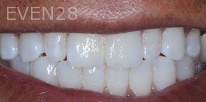 Joseph-Kabaklian-Teeth-Whitening-After-3