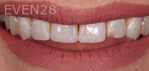 Joseph-Kabaklian-Teeth-Whitening-After-5
