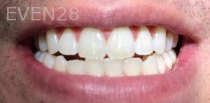 Joseph-Kabaklian-Teeth-Whitening-After-7