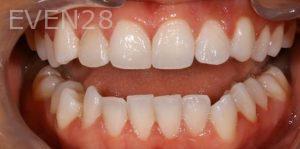 Joseph-Kabaklian-Teeth-Whitening-Before-1