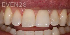 Joseph-Kabaklian-Teeth-Whitening-Before-2