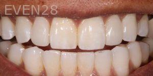 Joseph-Kabaklian-Teeth-Whitening-Before-3