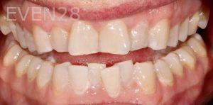 Joseph-Kabaklian-Teeth-Whitening-Before-4