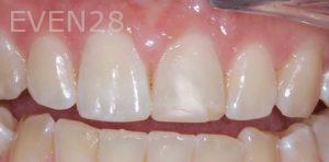 Joseph-Kabaklian-Teeth-Whitening-Before-6