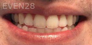 Joseph-Kabaklian-Teeth-Whitening-Before-7