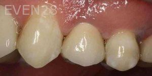Kenneth-Cho-Dental-Crowns-After-2