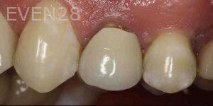 Kenneth-Cho-Dental-Crowns-Before-2