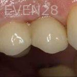 Kenneth-Cho-Dental-Implants-After-1