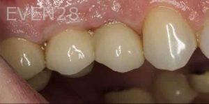 Kenneth-Cho-Dental-Implants-After-1