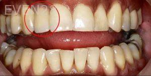 Kenneth-Cho-Dental-Implants-After-2