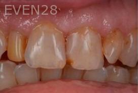 Matthew-Cilderman-dental-crown-before-4