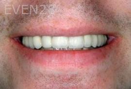 Matthew-Cilderman-dental-implants-after-1