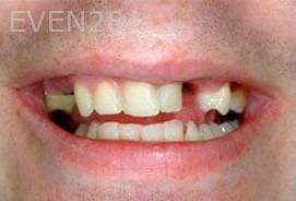 Matthew-Cilderman-dental-implants-before-1