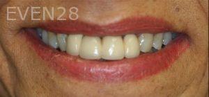 Michael-Mostofi-Dental-Crown-before-2