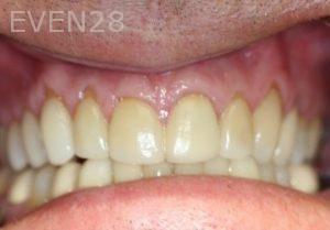 Michael-Mostofi-Dental-Crown-before-3