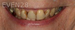 Michael-Mostofi-Dental-Crown-before-4
