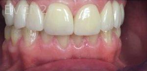 Parham-Akhavan-dental-implant-after-1