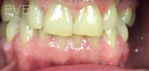Parham-Akhavan-dental-implant-before-1