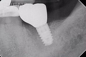 Sean-Saghatchi-Dental-Implanty-After-1c