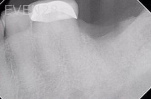 Sean-Saghatchi-Dental-Implanty-Before-1b