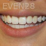 Todd-Emigh-Clear-Aligners-After-1