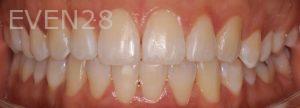 Todd-Emigh-Clear-Aligners-After-2