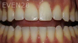 Todd-Emigh-Clear-Aligners-After-3