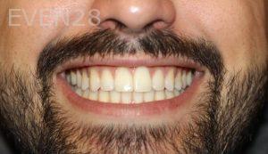 Todd-Emigh-Clear-Aligners-After-4