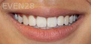 Todd-Emigh-Clear-Aligners-After-5