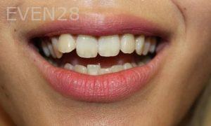 Todd-Emigh-Clear-Aligners-Before-1