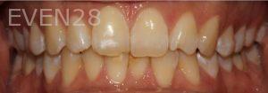 Todd-Emigh-Clear-Aligners-Before-2